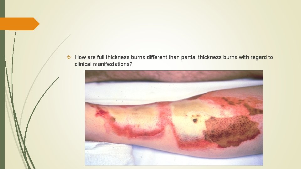  How are full thickness burns different than partial thickness burns with regard to