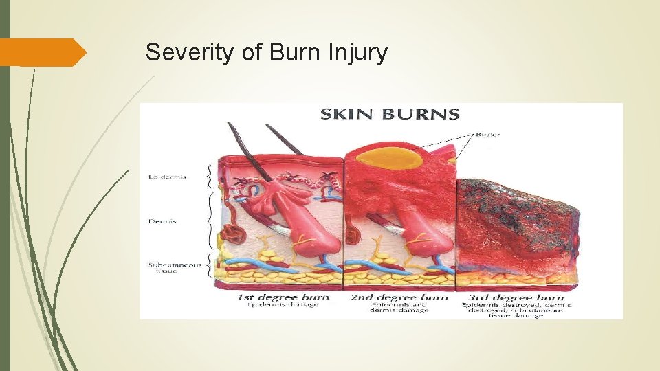 Severity of Burn Injury 