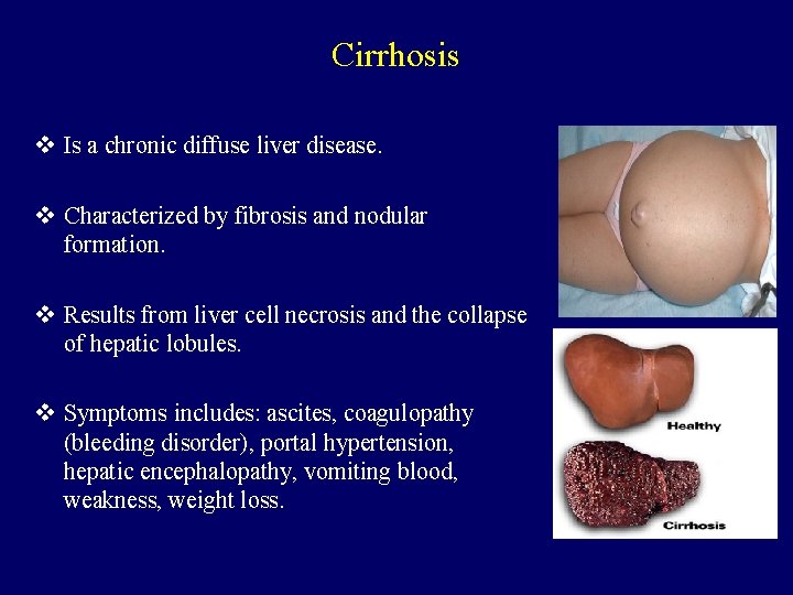 Cirrhosis v Is a chronic diffuse liver disease. v Characterized by fibrosis and nodular