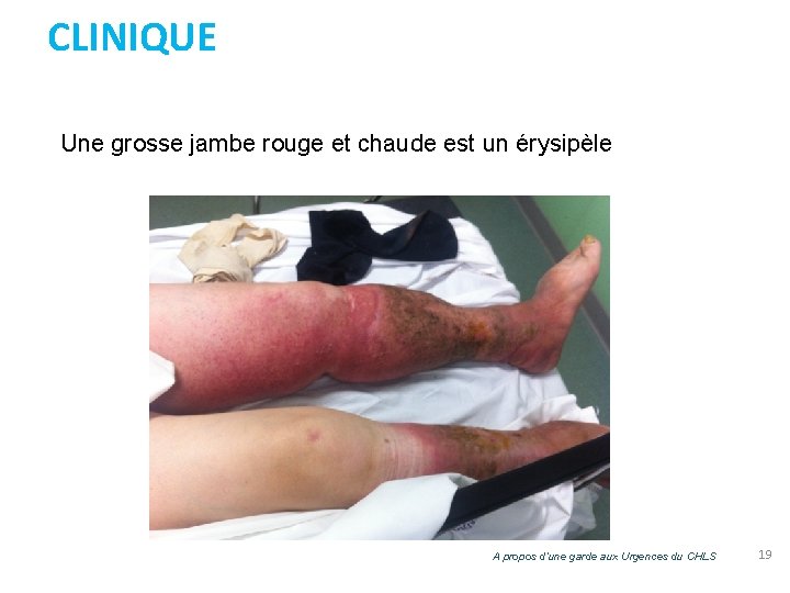 CLINIQUE Une grosse jambe rouge et chaude est un érysipèle A propos d’une garde