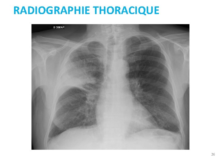 RADIOGRAPHIE THORACIQUE 26 