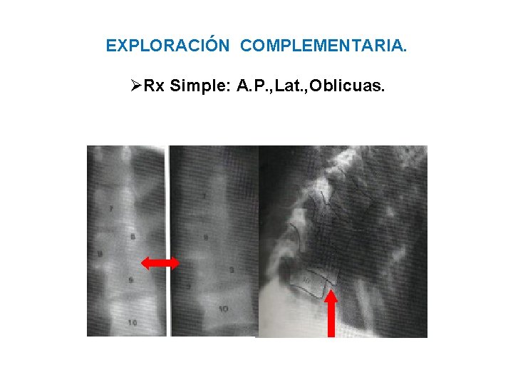 EXPLORACIÓN COMPLEMENTARIA. ØRx Simple: A. P. , Lat. , Oblicuas. 