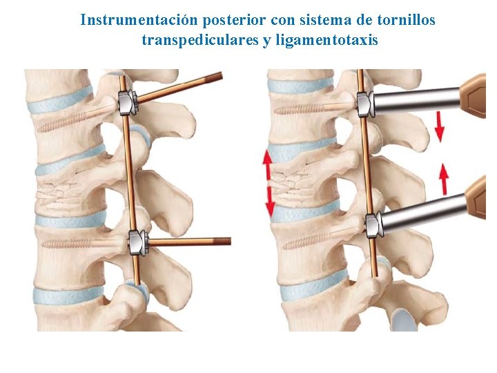 Instrumentación posterior con sistema de tornillos transpediculares y ligamentotaxis 