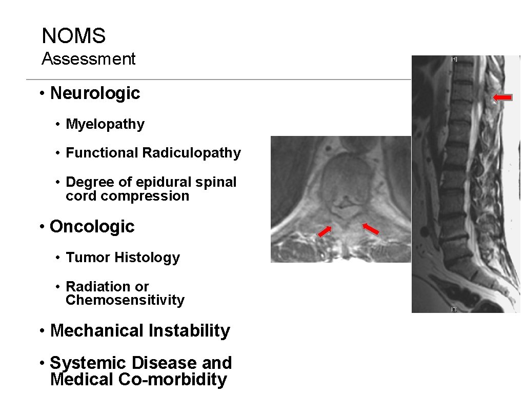 NOMS Assessment • Neurologic • Myelopathy • Functional Radiculopathy • Degree of epidural spinal