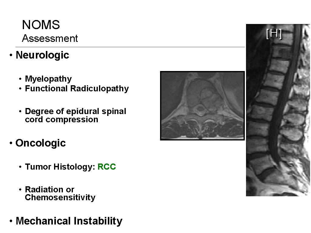 NOMS Assessment • Neurologic • Myelopathy • Functional Radiculopathy • Degree of epidural spinal