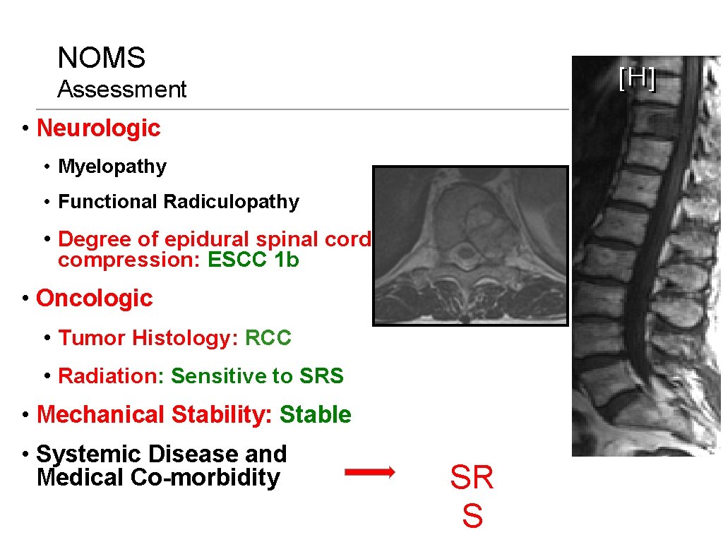 NOMS Assessment • Neurologic • Myelopathy • Functional Radiculopathy • Degree of epidural spinal