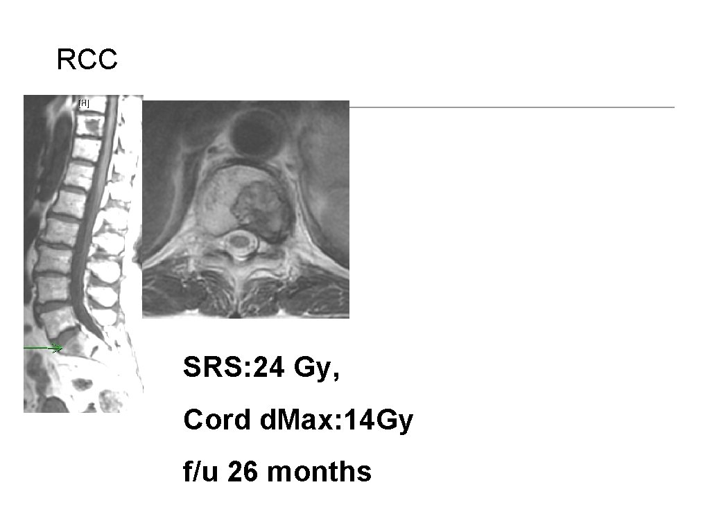 RCC SRS: 24 Gy, Cord d. Max: 14 Gy f/u 26 months Bilsky M,