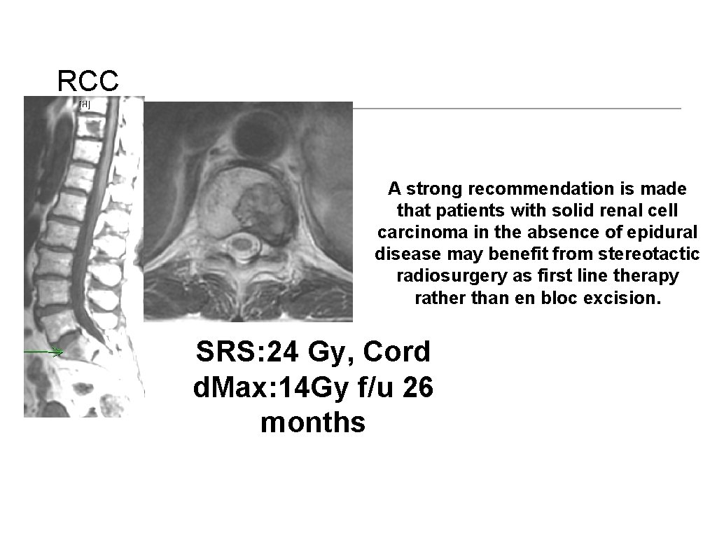 RCC A strong recommendation is made that patients with solid renal cell carcinoma in