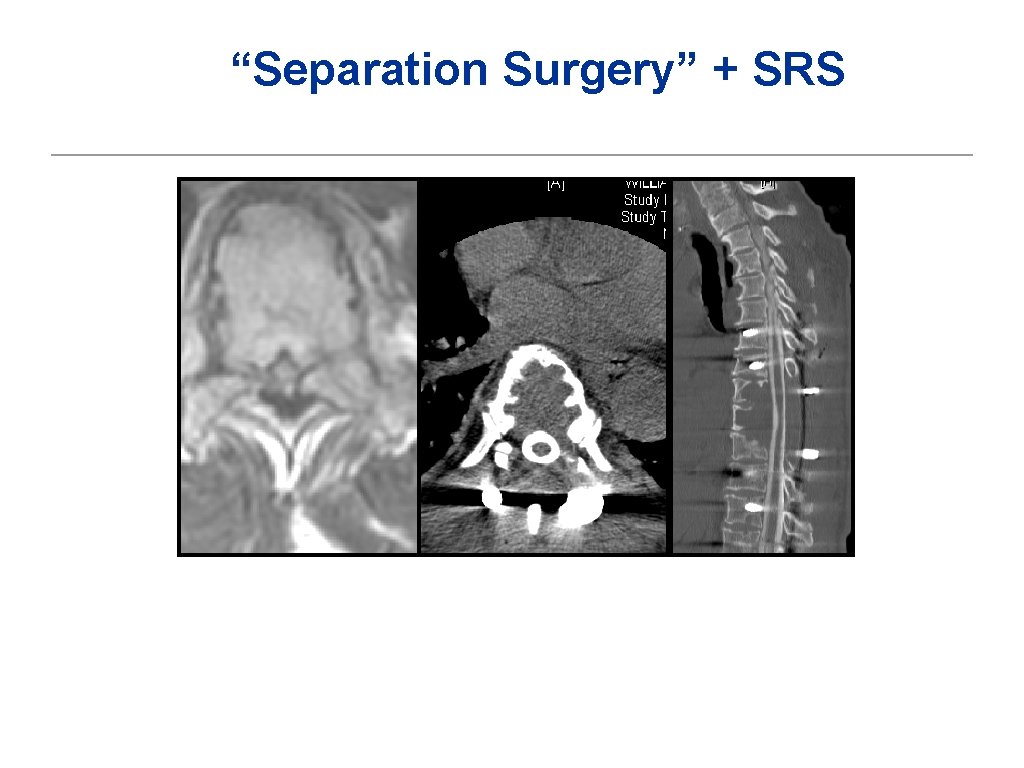 “Separation Surgery” + SRS 