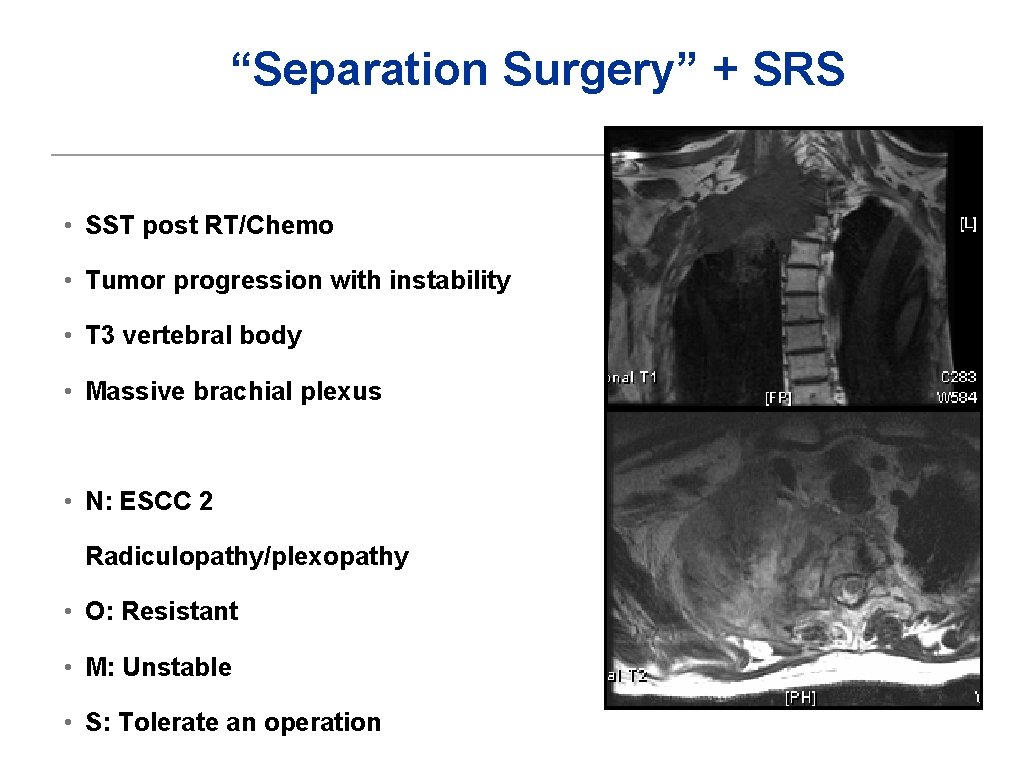 “Separation Surgery” + SRS • SST post RT/Chemo • Tumor progression with instability •