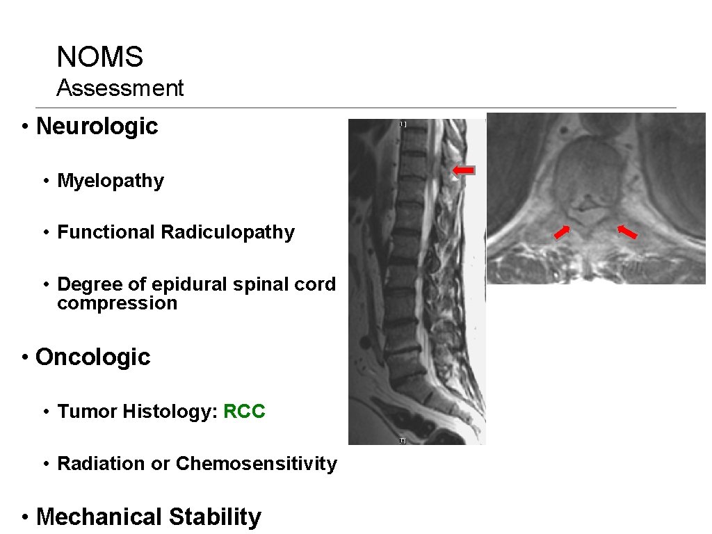 NOMS Assessment • Neurologic • Myelopathy • Functional Radiculopathy • Degree of epidural spinal