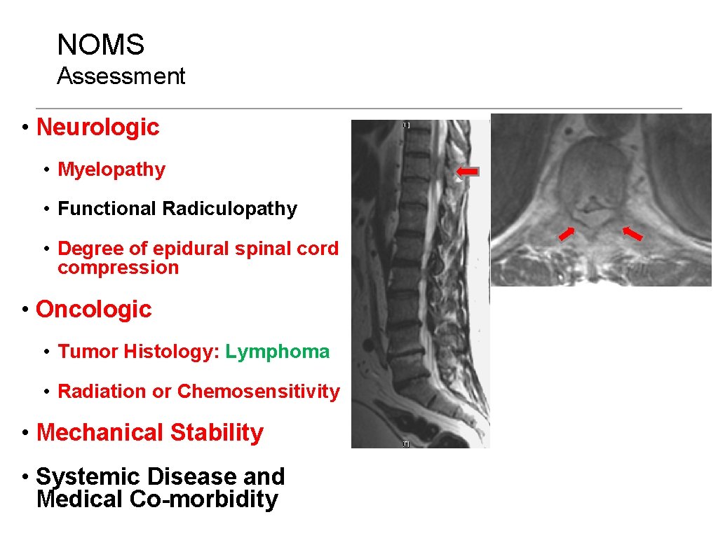 NOMS Assessment • Neurologic • Myelopathy • Functional Radiculopathy • Degree of epidural spinal