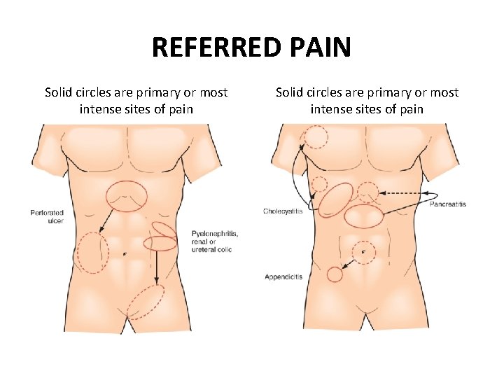 REFERRED PAIN Solid circles are primary or most intense sites of pain 