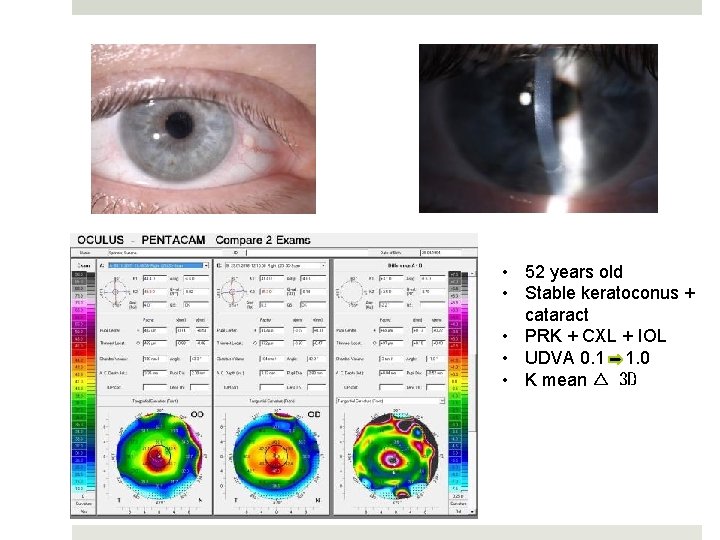  • 52 years old • Stable keratoconus + cataract • PRK + CXL