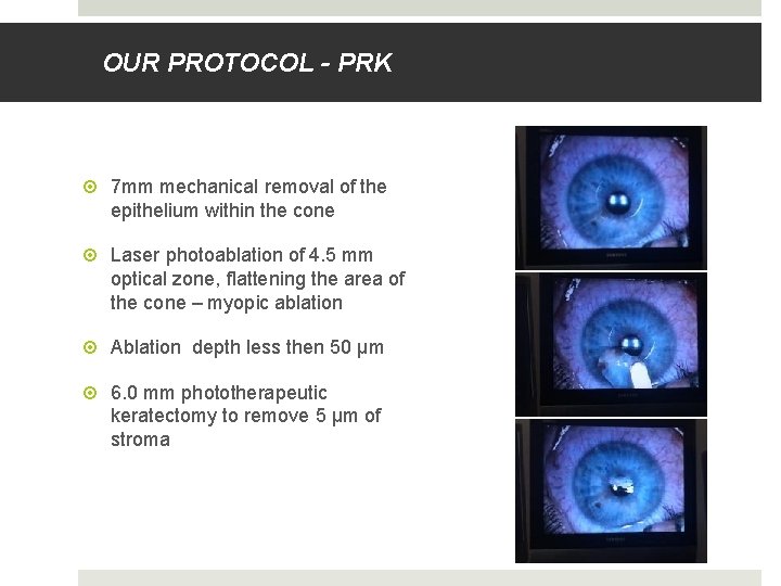 OUR PROTOCOL - PRK 7 mm mechanical removal of the epithelium within the cone