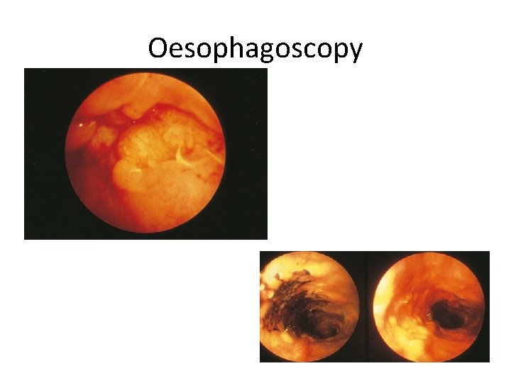 Oesophagoscopy 