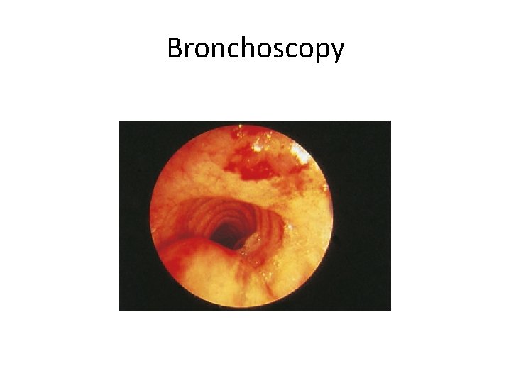 Bronchoscopy 