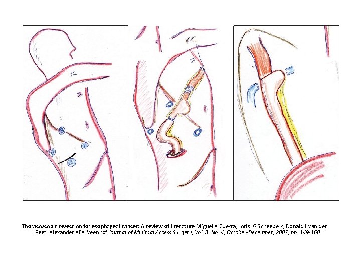 Thoracoscopic resection for esophageal cancer: A review of literature Miguel A Cuesta, Joris JG