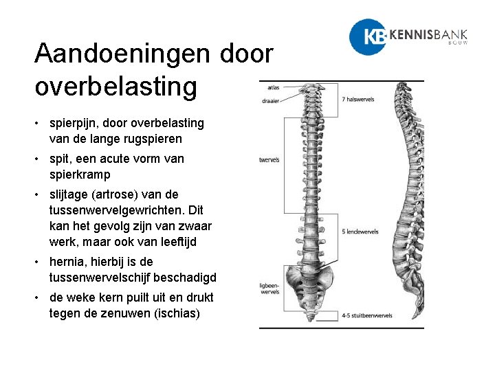 Aandoeningen door overbelasting • spierpijn, door overbelasting van de lange rugspieren • spit, een