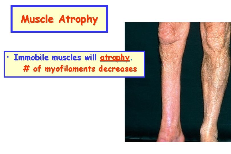 Muscle Atrophy • Immobile muscles will atrophy. # of myofilaments decreases 