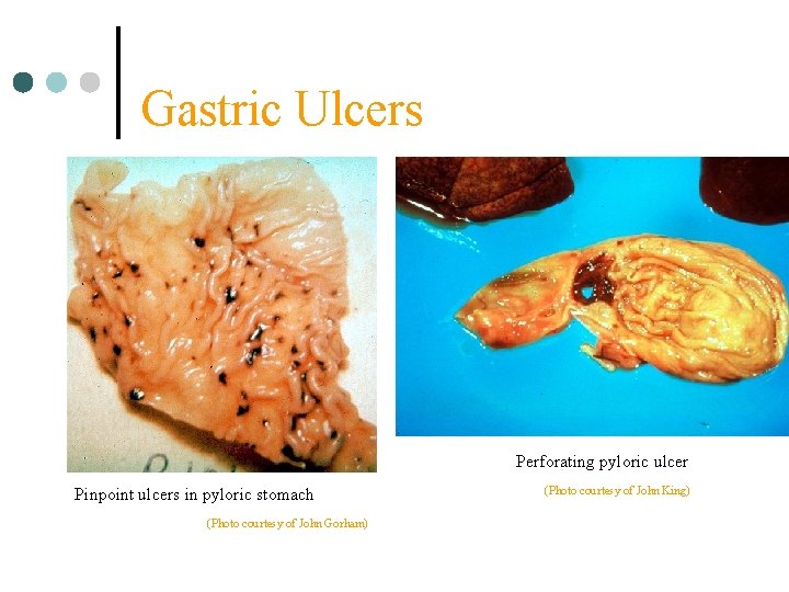 Gastric Ulcers Perforating pyloric ulcer Pinpoint ulcers in pyloric stomach (Photo courtesy of John