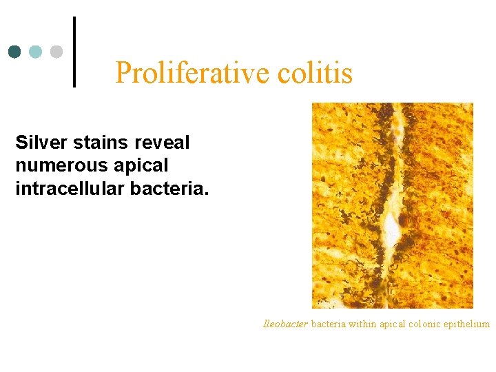 Proliferative colitis Silver stains reveal numerous apical intracellular bacteria. Ileobacteria within apical colonic epithelium