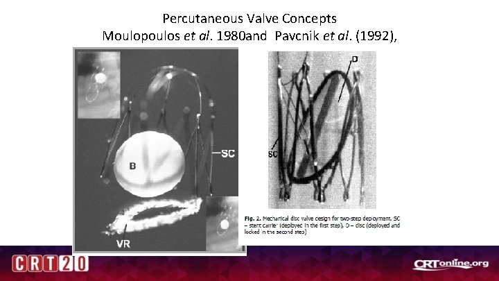 Percutaneous Valve Concepts Moulopoulos et al. 1980 and Pavcnik et al. (1992), 