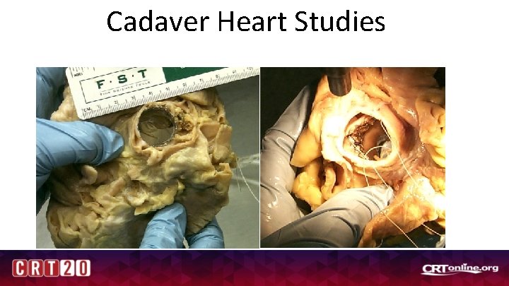 Cadaver Heart Studies 
