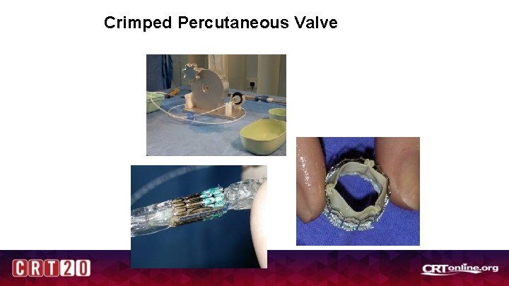 Crimped Percutaneous Valve 