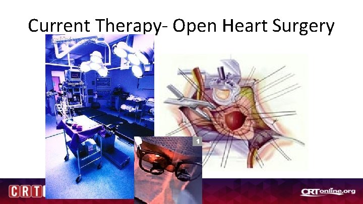 Current Therapy- Open Heart Surgery 