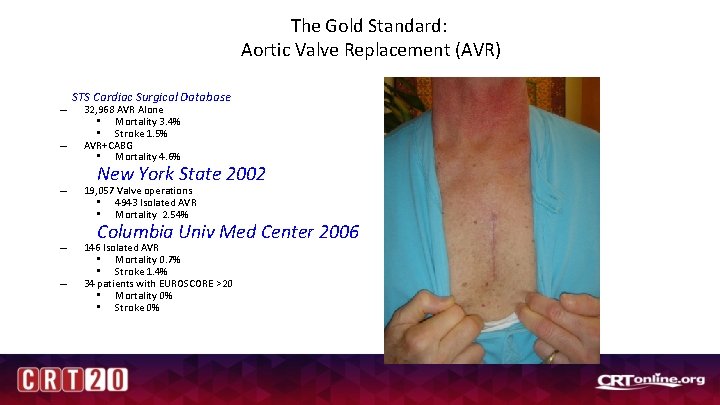 The Gold Standard: Aortic Valve Replacement (AVR) – – STS Cardiac Surgical Database 32,