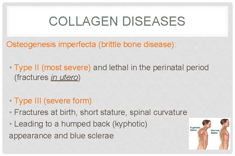 COLLAGEN DISEASES Osteogenesis imperfecta (brittle bone disease): • Type II (most severe) and lethal