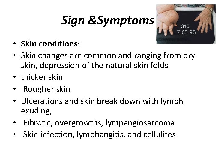 Sign &Symptoms • Skin conditions: • Skin changes are common and ranging from dry