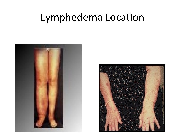 Lymphedema Location 