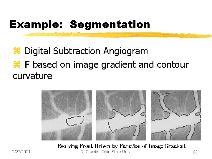 Example: Segmentation z Digital Subtraction Angiogram z F based on image gradient and contour