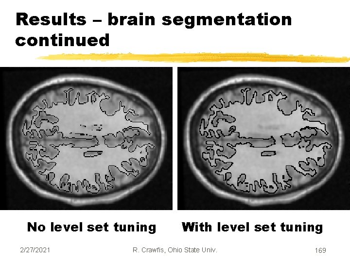 Results – brain segmentation continued No level set tuning 2/27/2021 With level set tuning