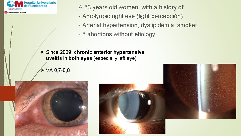 A 53 years old women with a history of: - Amblyopic right eye (light