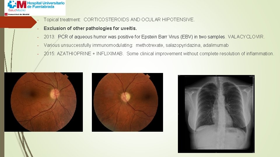 - Topical treatment: CORTICOSTEROIDS AND OCULAR HIPOTENSIVE. - Exclusion of other pathologies for uveítis.