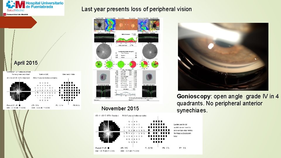 Last year presents loss of peripheral vision April 2015 November 2015 Gonioscopy: open angle
