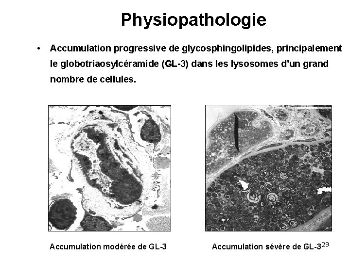 Physiopathologie • Accumulation progressive de glycosphingolipides, principalement le globotriaosylcéramide (GL-3) dans les lysosomes d’un