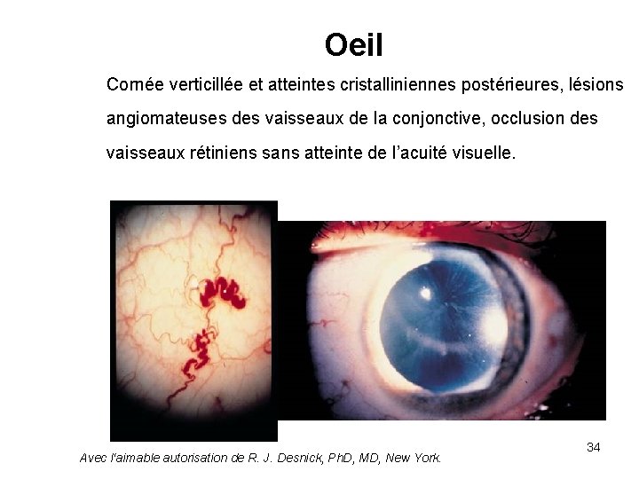Oeil Cornée verticillée et atteintes cristalliniennes postérieures, lésions angiomateuses des vaisseaux de la conjonctive,