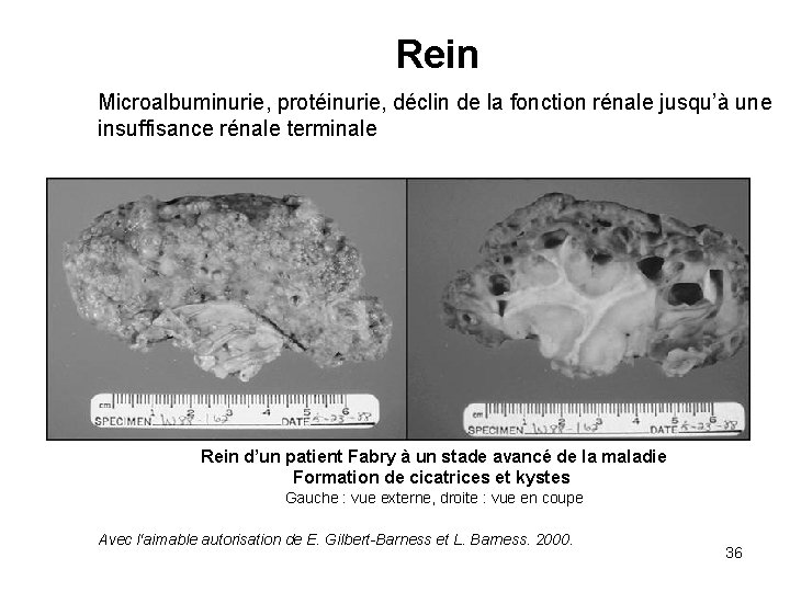 Rein Microalbuminurie, protéinurie, déclin de la fonction rénale jusqu’à une insuffisance rénale terminale Rein