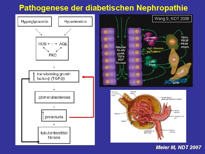 Pathogenese der diabetischen Nephropathie Wang S, NDT 2008 Meier M, NDT 2007 