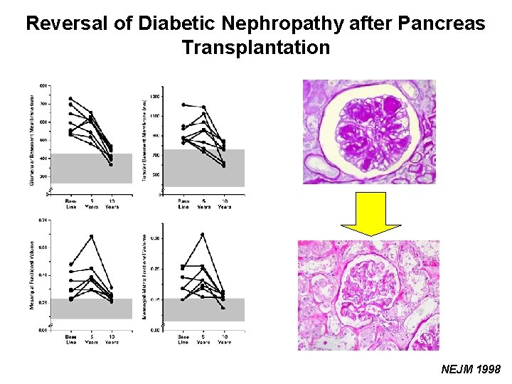 Reversal of Diabetic Nephropathy after Pancreas Transplantation NEJM 1998 