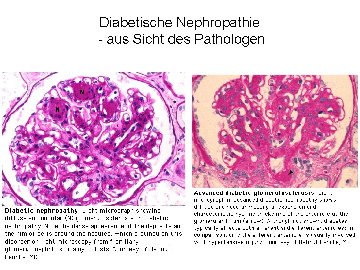 Diabetische Nephropathie - aus Sicht des Pathologen 