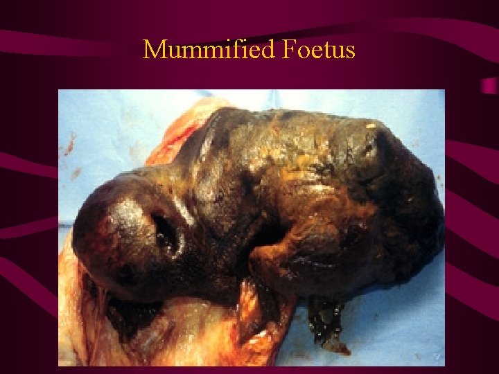 Mummified Foetus 