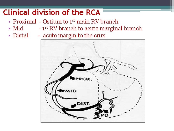 Clinical division of the RCA • Proximal - Ostium to 1 st main RV