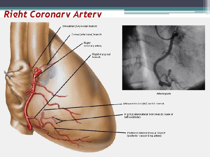 Right Coronary Artery 