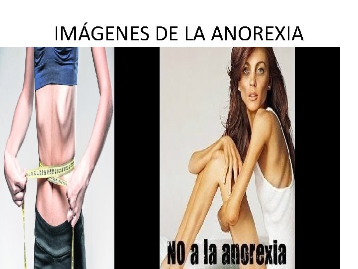 IMÁGENES DE LA ANOREXIA 