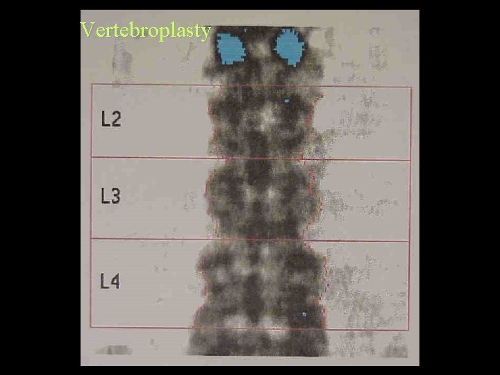 Vertebroplasty 